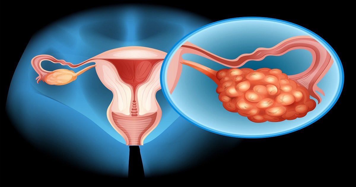 PCOD/PCOS Treatment