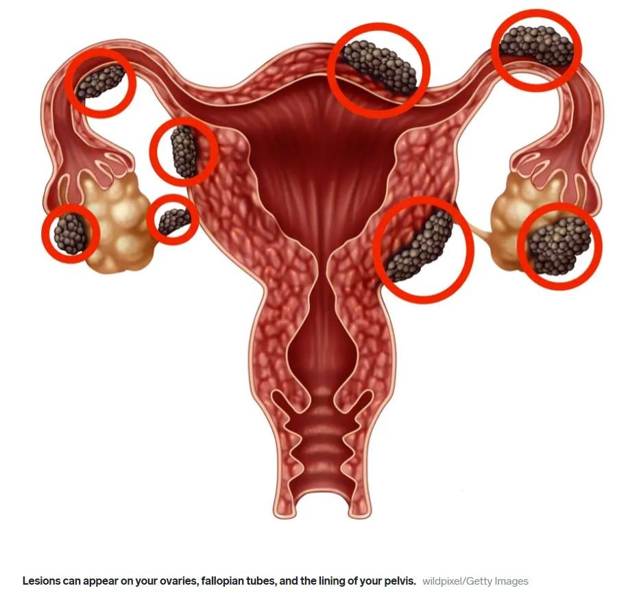 Endometriosis Treatment